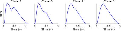 Clustered photoplethysmogram pulse wave shapes and their associations with clinical data